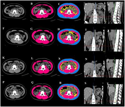 Association of longitudinal changes in skeletal muscle mass with prognosis and nutritional intake in acutely hospitalized patients with abdominal trauma: a retrospective observational study